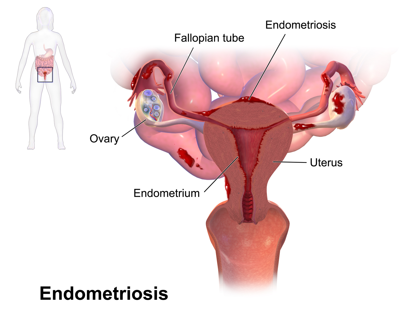 Getting Pregnant With Endometriosis